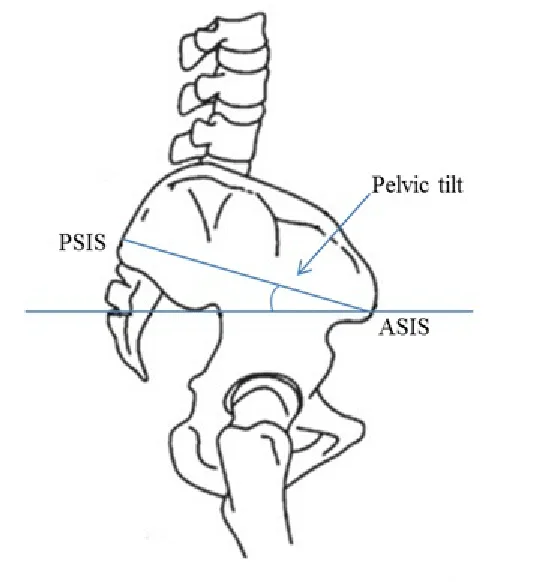 PSIS-ASIS Pelvic Tilt