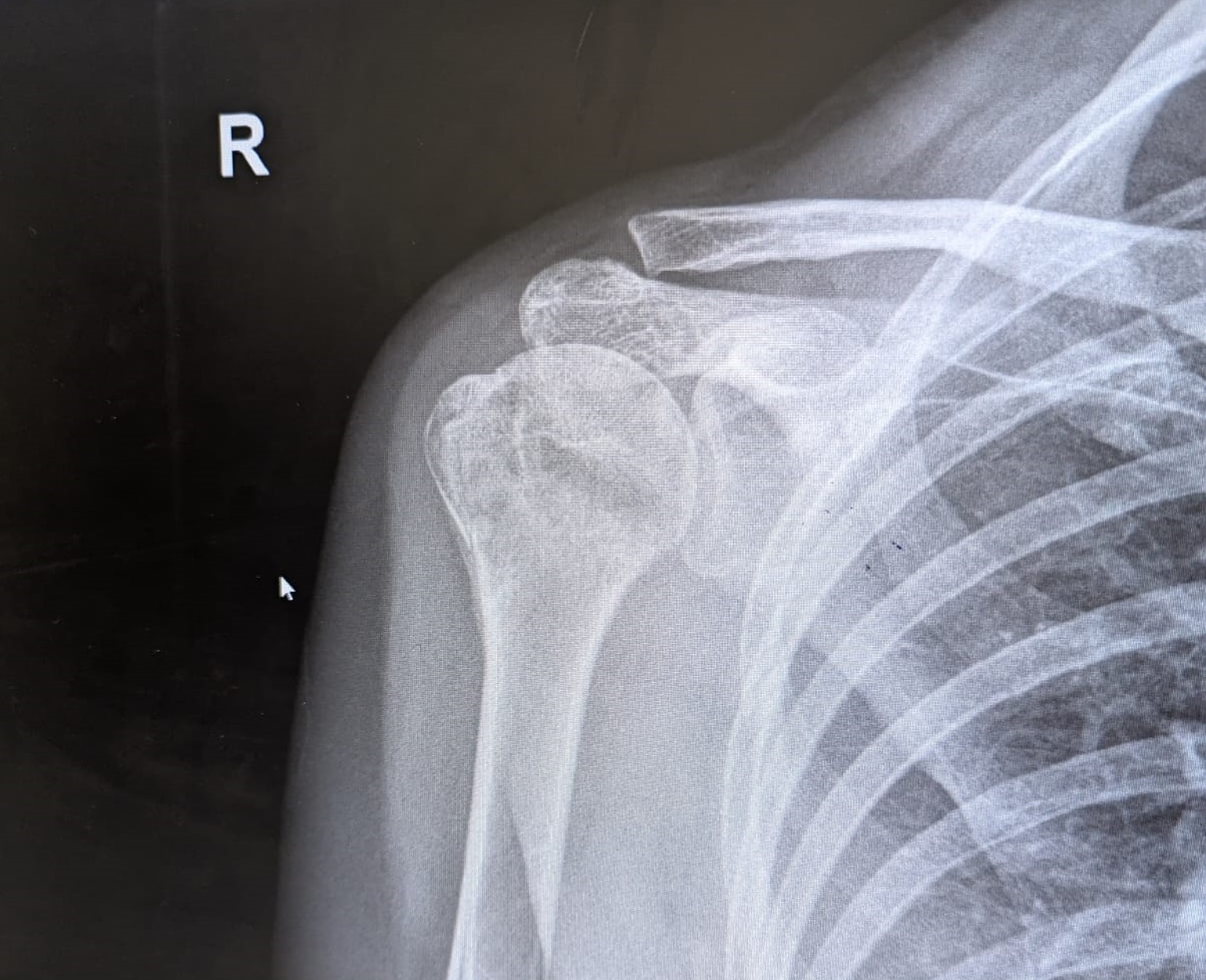 PHOTO-2025-03-10-17-38-21 X-Ray of Chloe's Shoulder showing fracture. Substained months before the Mongol Derby 2025